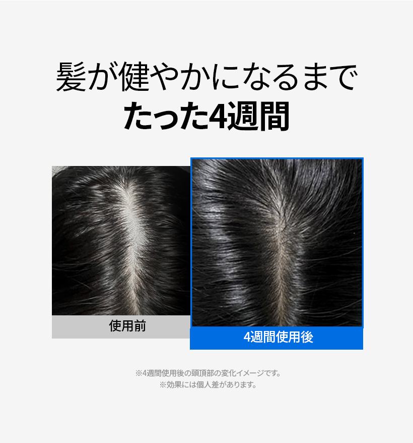 使用前と4週間使用後の頭頂部比較